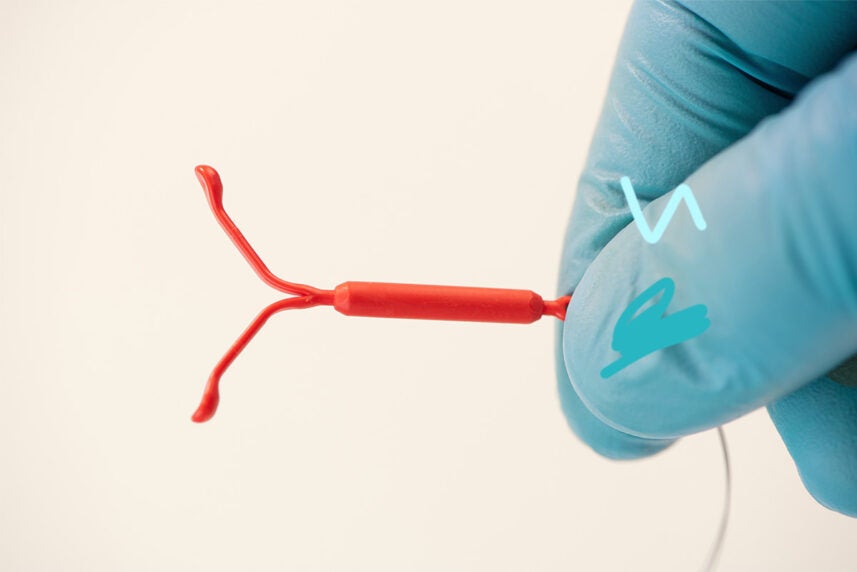 Weight loss after IUD removal causes and symptoms Optum Perks